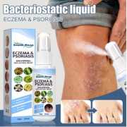 Natural Herb Eczema Dermatitis Psoriasis Treatment Spray